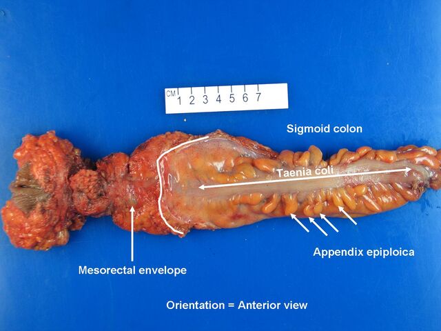 File:Rectum anterior view.jpg
