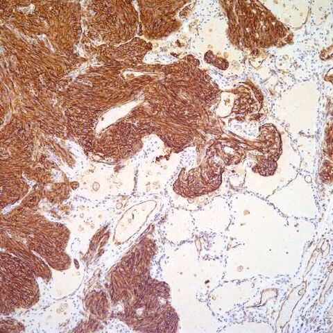 File:CD31.metastatic spindle cell angiosarcoma.2.jpg