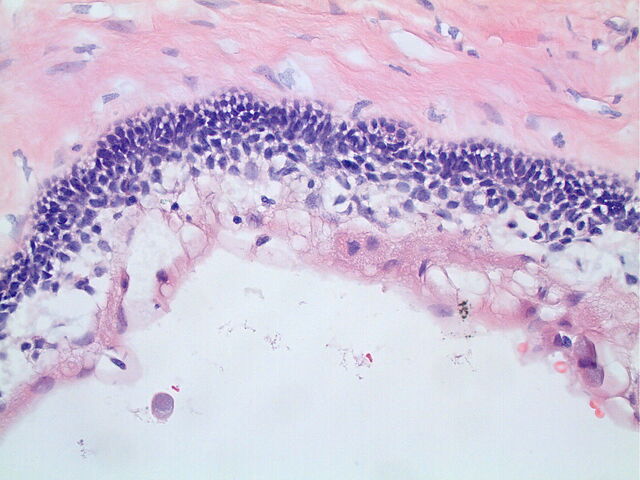 File:Ameloblastic epithelium 40X.jpg
