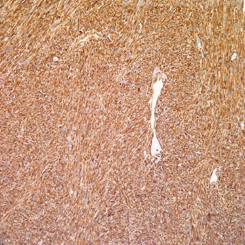 File:Vimentin.cardiac myosarcoma.1.jpg