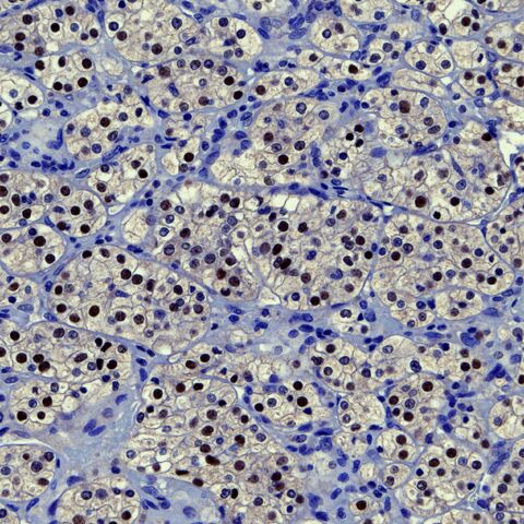 File:Clear cell RCC Pax-8.jpg