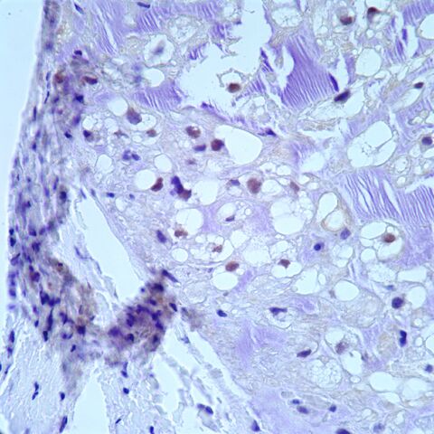 File:Brachyury.chordoma.2.jpg