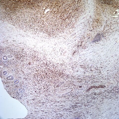 File:S100.desmoplastic neurotropic melanoma.7.jpg