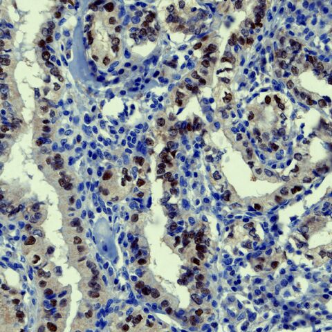 File:Thyroid micropapillary carcinoma S10-903HHP.jpg