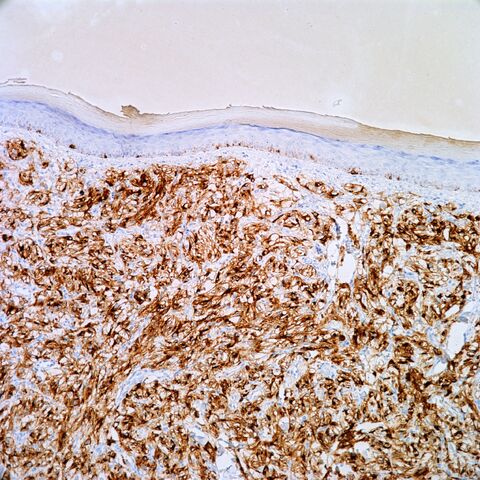 File:HMB45.cutaneous pecoma.jpg