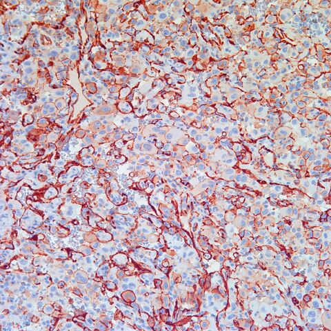 File:CD31.epithelioid angiosarcoma.1.jpg