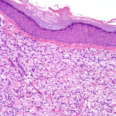 File:Pecoma.cutaneous.HE.200x.2-2.jpg