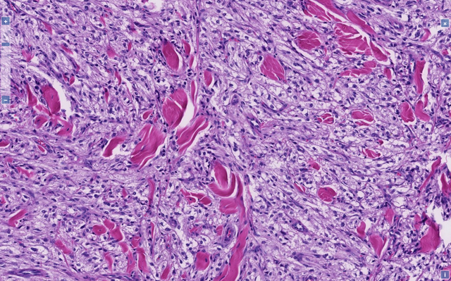 File:Primary Cutaneous PEComa high.png