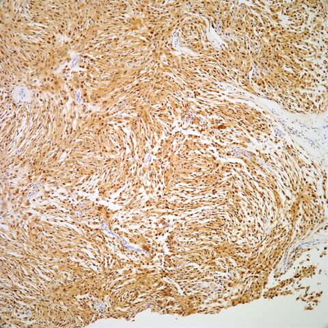 File:MiTF.cellular neurothekeoma.1.jpg
