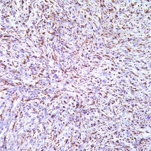 File:Factor XIIIa.13a.PUS.sarcoma.2.jpg