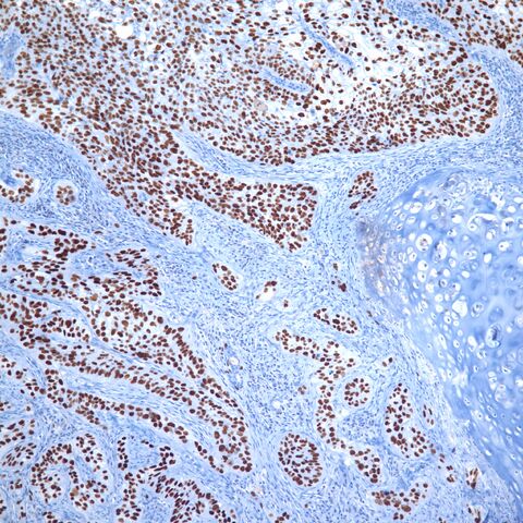 File:P63.squamous cell carcinoma.lung.jpg