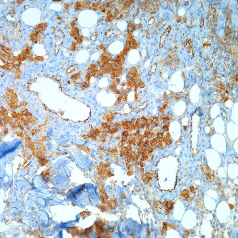 File:CD31.histiocytes.1.jpg