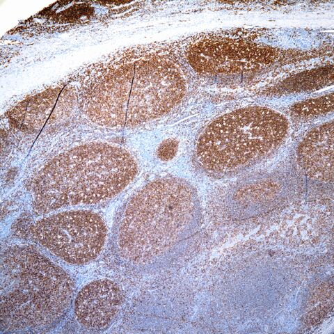 File:CD20.tonsil.2.jpg