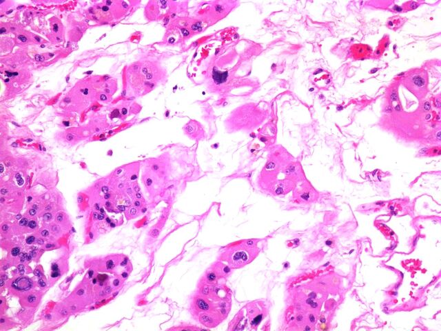 File:Oncocytoma with Degenerative Atypia3.jpg