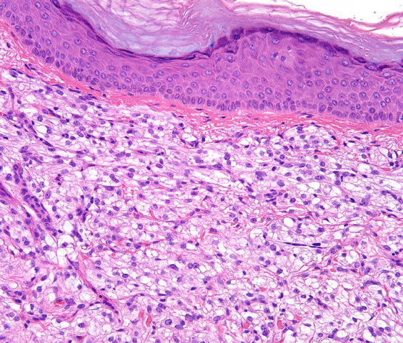 File:Cropped pecoma.cutaneous.HE.200x.2-2.jpg