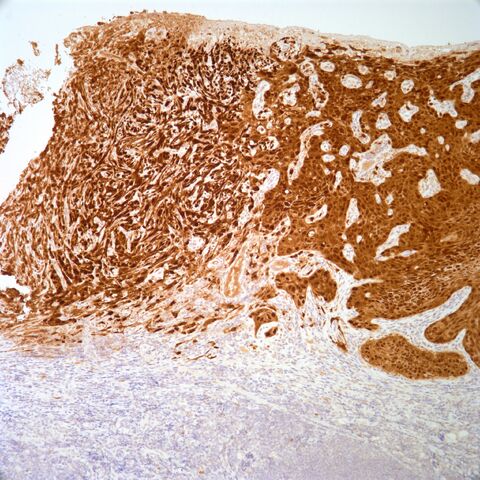 File:P16.squamous cell carcinoma.2.jpg