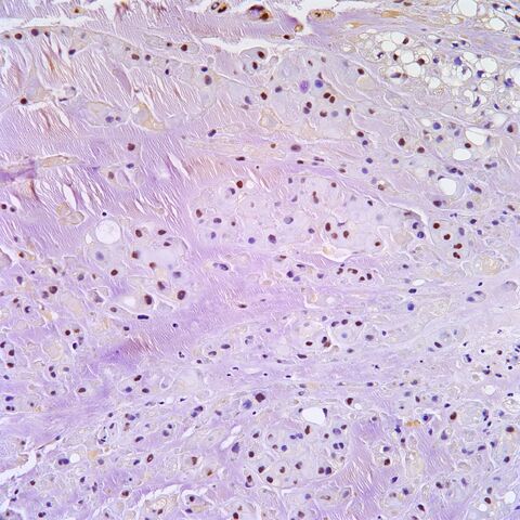 File:Brachyury.chordoma.4.jpg