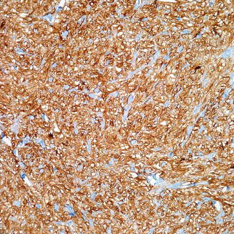 File:CD10.cutaneous pecoma.100x.2.jpg