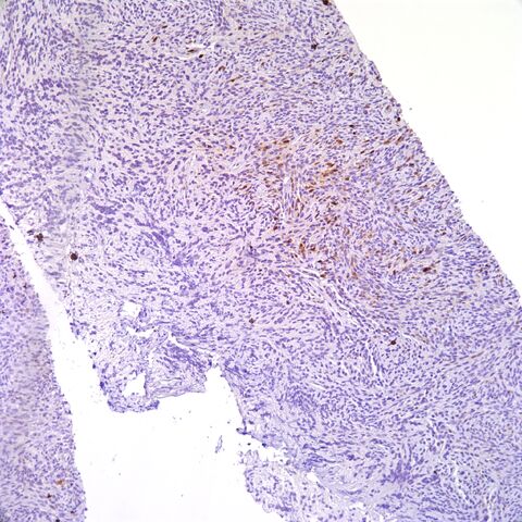 File:S100.MPNST.focal.1.jpg