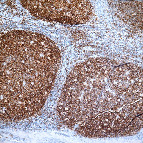 File:CD20.tonsil.1.jpg