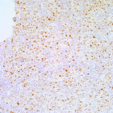 File:MiTF.met melanoma.1.jpg