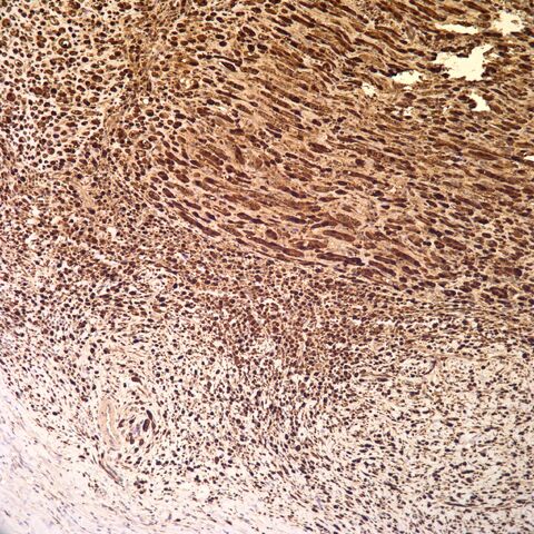 File:S100.desmoplastic neurotropic melanoma.4.jpg