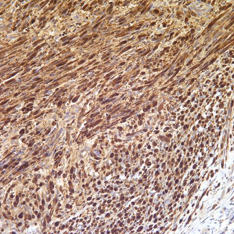 File:S100.desmoplastic neurotropic melanoma.1.jpg