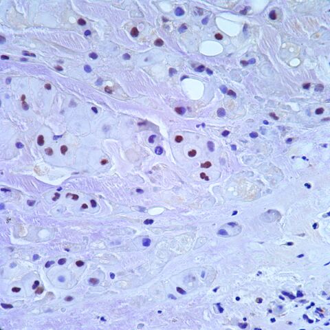 File:Brachyury.chordoma.3.jpg