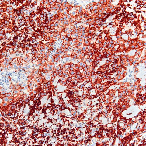 File:CD10.epithelioid angiosarcoma.1.jpg