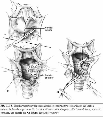File:Hemilaryngectomy.jpg