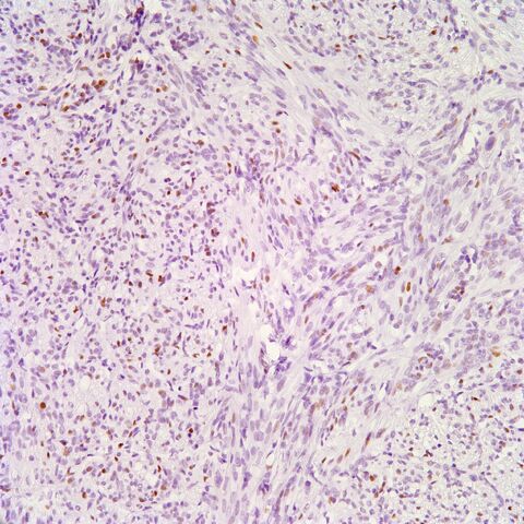 File:ER.AML with cyst.3.jpg