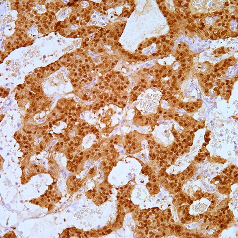 File:Beta-catenin.solid pseudopapillary tumor.200x.jpg