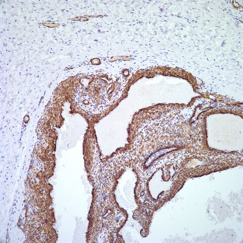 File:MSA.glomangioma.jpg