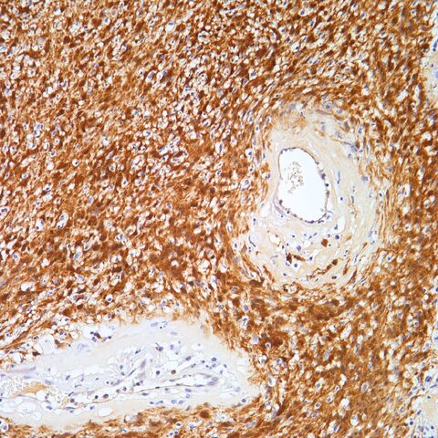File:S100.schwannoma.jpg