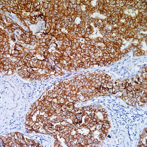 File:Her2.breast carcinoma.200x.jpg