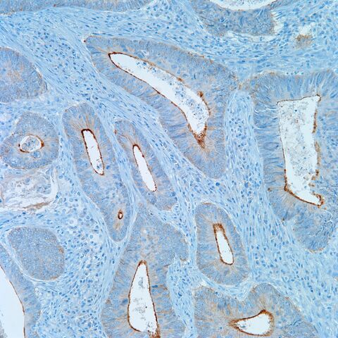 File:Villin.colonic adenoca.2.jpg