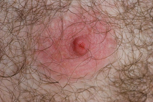File:Joggers Nipple.jpg