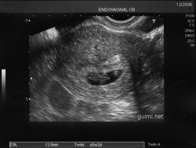 File:Scan07semanas.png