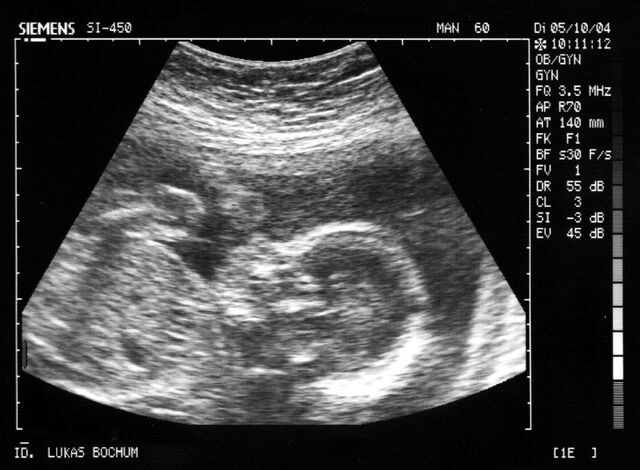File:Baby sonic 23 week.jpg