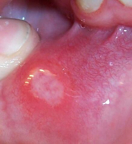 File:Canker sore.jpg