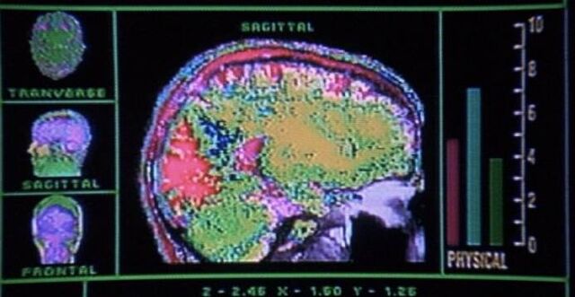 File:Rocky brain condition.jpg