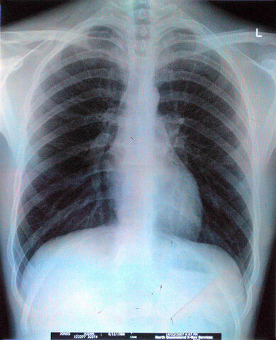 File:Chest x-ray.jpg