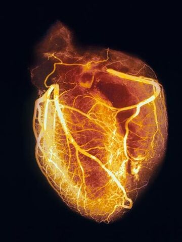 File:Heart-angiogram 986 600x450.jpg