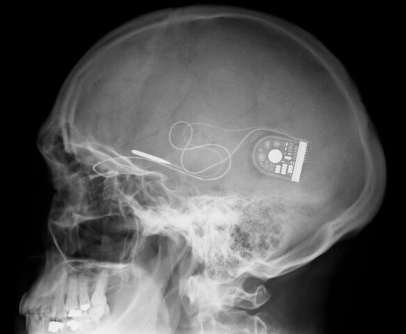 File:Implanted Computer.jpg
