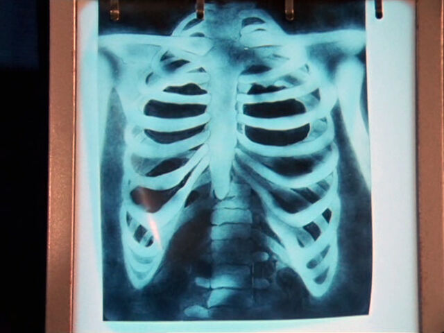 File:ThirdDoctor-ChestXRay.jpg