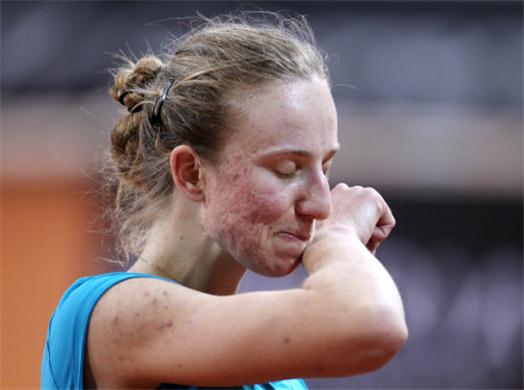 Mona Barthel Akne Mona Barthel Akne