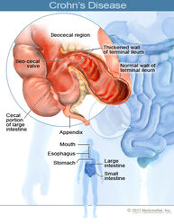 2011-crohns-disease
