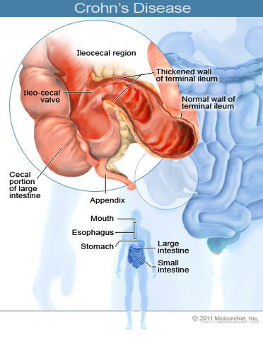 File:2011-crohns-disease.jpg
