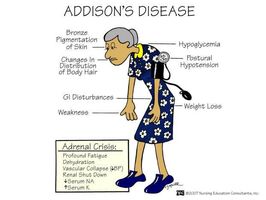 Addison's Disease