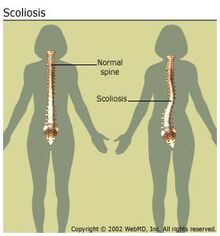 Arthritis-scoliosis scoliosisspine